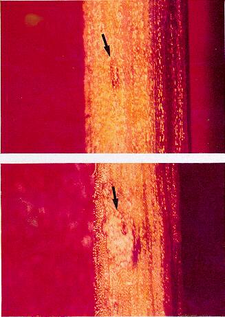 FIGURA 1. Antracnosis en hoja de Coffea arabica L. L�mina foliar con s�ntomas generalizados(a).