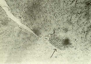 Figura 7. tero con infiltracin focal de linfocitos. H.E. 10x.