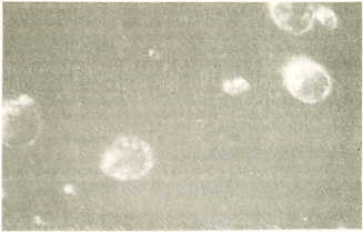 FIGURA 1. Linfoscitos con sig (Linfocitos B) (40x).