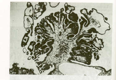 FIGURA 5.Micrografa de cistoadenocarcinoma papilar (Caso No.5) mostrando crecimiento papilomatoso (P). HE: 140x.