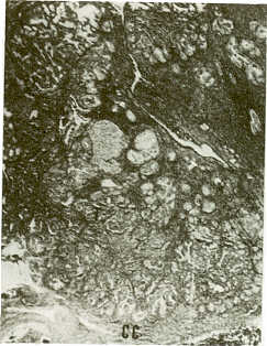FIGURA 8.Micrografa de Ad de ovario en un canino de la raza Pastor Alemn de 12 aos (Caso No.19). Obsrvese amplia rea tumoral (T) delimitada por cpsula delgada de tejido conectivo (CC). HE: 40x.