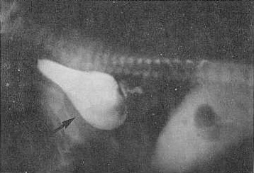 Fig. 2. Rayos X mostrando una diverticulosis esofgica por persistencia del arco rtico.