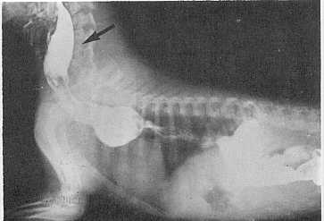 Fig. 3. La radiografa muestra un caso de acalasia esofgica.